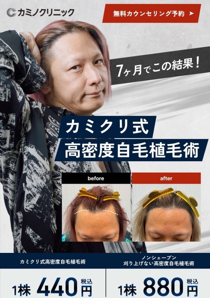 東京・銀座で自毛植毛手術のおすすめは？ クリニックの費用比較 – 髪の